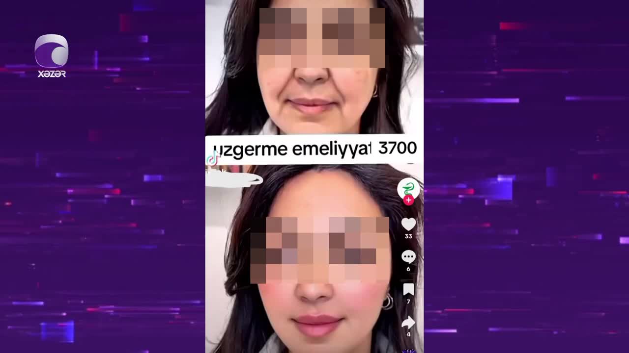 “Estetik əməliyyatdan sonra üzüm deformasiyaya uğrayıb” 