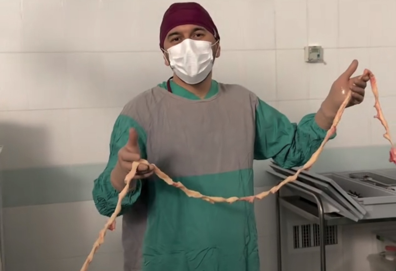 3,5 metr “kista” çıxarıldı – Dünyada ilk ola bilər