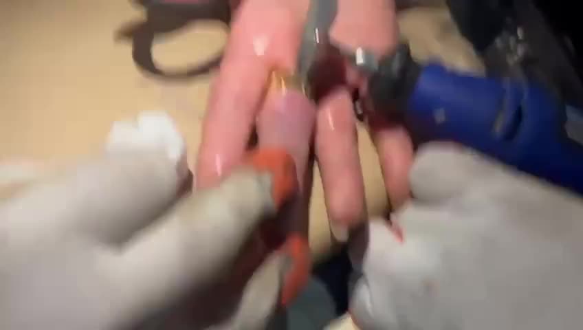 Barmağında sıxışan üzüyü belə çıxardılar