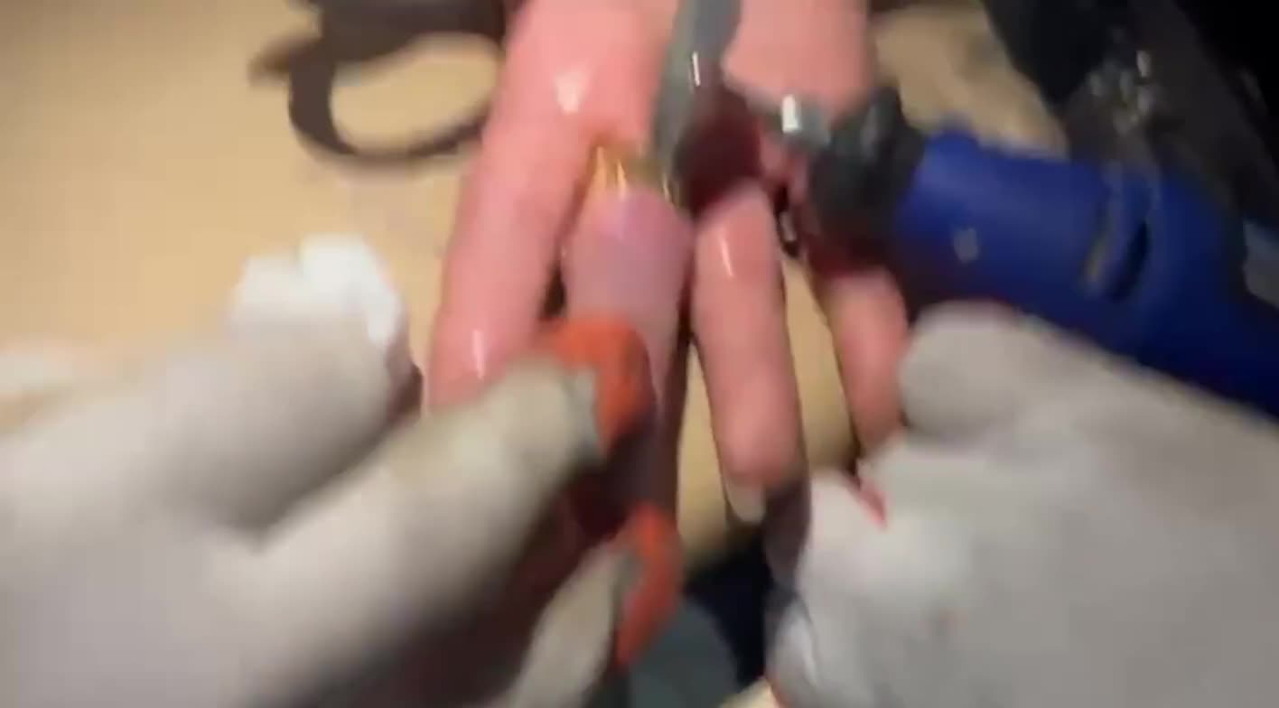 Barmağında sıxışan üzüyü belə çıxardılar